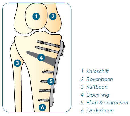 Tibiakop osteotomie Tibiakop osteotomie