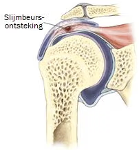 Schouder ontsteking