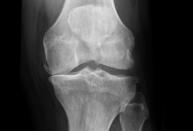 Fysiotherapie of prothese bij deze versleten knie?